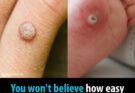Say Goodbye to Skin Tags and Warts: Easy Removal with Hydrogen Peroxide…. see more👇